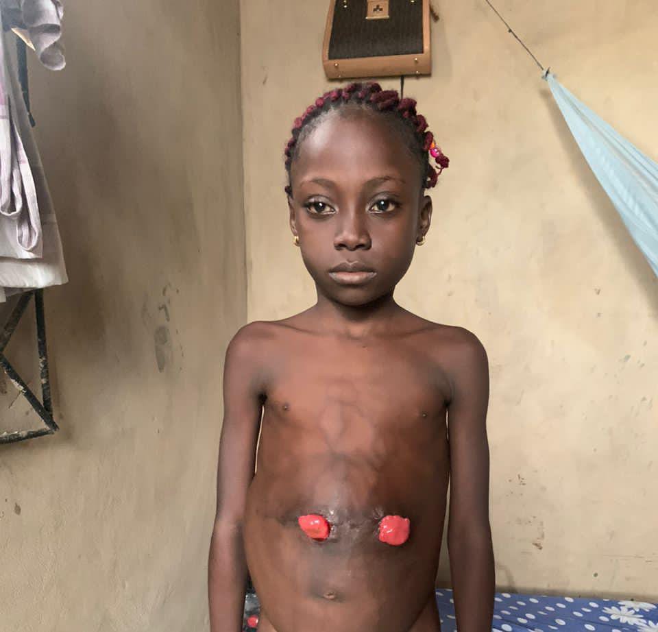 Callous! Father of Baby born with deformity absconds, tells wife to throw her into the bush… wife cries out, seeks N15m financial assistance to save her
